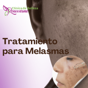TRATAMIENTOS FACIALES EN CLINICA DE BELLEZA RENOVARME, TRATAMIENTOS PARA LA ALOPECIA, CLINICA DE PELO (4)
