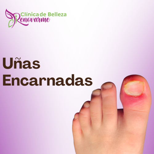 tratamientos de uñas encarnadas, tratamientos para hongos en uñas, pedicure clinico, tratamiento laser para hongos en uñas, clinica delpie, clinica de pies y uñas (1) tratamientos de uñas encarnadas, tratamientos para hongos en uñas, pedicure clinico, tratamiento laser para hongos en uñas, clinica delpie, clinica de pies y uñas (1)