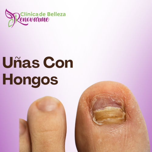 tratamientos de uñas encarnadas, tratamientos para hongos en uñas, pedicure clinico, tratamiento laser para hongos en uñas, clinica delpie, clinica de pies y uñas (2) tratamientos de uñas encarnadas, tratamientos para hongos en uñas, pedicure clinico, tratamiento laser para hongos en uñas, clinica delpie, clinica de pies y uñas (2)